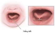 Quan sát lưỡi của bé lúc mới sinh để nhận biết sớm dính thắng lưỡi ở trẻ