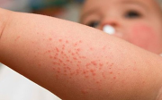 Trẻ bị sốt xuất huyết điều trị ở nhà khi nào cần nhập viện?