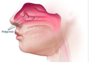 Cách điều trị và phòng ngừa polyp mũi hiệu quả