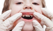 Dấu hiệu nhận biết sớm sâu răng ở trẻ
