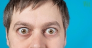 Cẩn trọng biến chứng lồi mắt ở người bị cường giáp