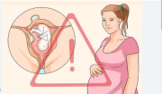 Thai phụ mắc u xơ tử cung có thể có nguy cơ bị sảy thai, sinh non