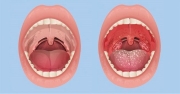 Viêm họng: Các triệu chứng thường gặp và khi nào thì nên đi gặp bác sĩ