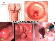 Dấu hiệu nhận biết Polyp cổ tử cung dễ nhầm lẫn bệnh khác