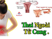 Mang thai ngoài tử cung: Nguyên nhân, triệu chứng, điều trị và phòng ngừa