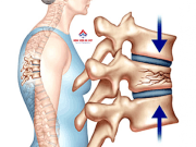 Xẹp đốt sống do nguyên nhân gì, phòng ngừa thế nào?