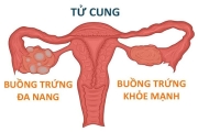 U nang buồng trứng hai bên có nguy hiểm không?