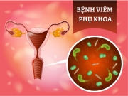 Bị viêm phụ khoa đừng ăn những thực phẩm sau