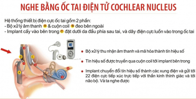 Chỉ định Cấy ốc tai điện tử cho những đối tượng nào?