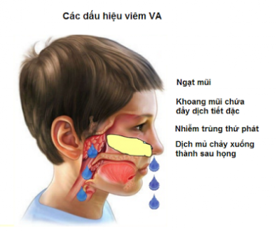 Những biểu hiện viêm VA ở trẻ cần chú ý