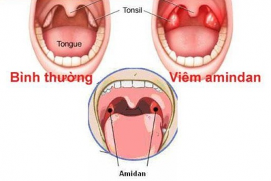 Viêm Amidan cấp là bệnh gì?