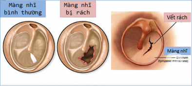 6 câu hỏi thường gặp liên quan đến thủng màng nhĩ có tự lành không?