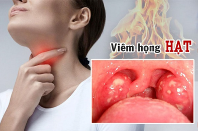 Bệnh viêm họng hạt có nguy hiểm không và những lưu ý để điều trị dứt điểm?