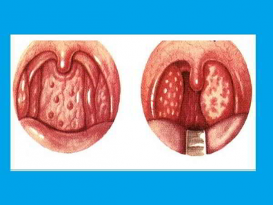 Bệnh viêm họng hạt ở trẻ em - nguyên nhân, triệu chứng và cách điều trị hiệu quả