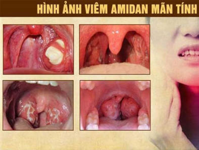 Bị bệnh viêm amidan mãn tính có chữa được không?