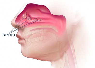 Cách làm teo polyp mũi an toàn và hiệu quả nhất