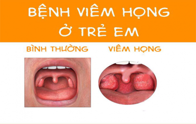 Dấu hiệu viêm họng ở trẻ nhỏ như thế nào?