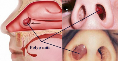 Điều trị polyp mũi tại nhà có tốt không? Các cách điều trị polyp mũi hiệu quả nhất