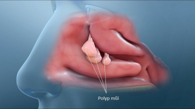 Đốt polyp mũi có hiệu quả không? Địa chỉ đốt polyp an toàn và uy tín