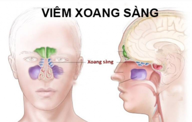 KHI NÀO CẦN MỔ XOANG SÀNG VÀ MỔ XOANG BƯỚM?