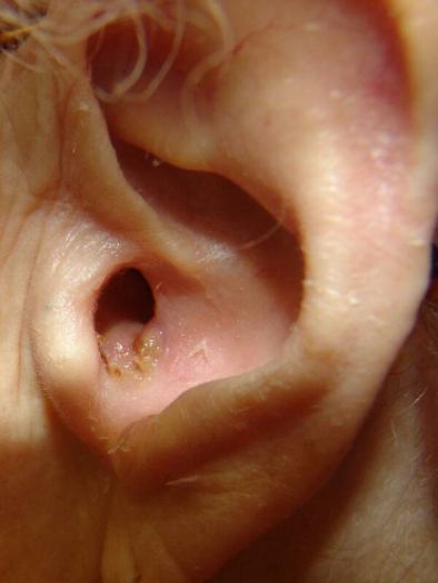 Nguyên nhân gây ra viêm ống tai ngoài có mủ là gì?