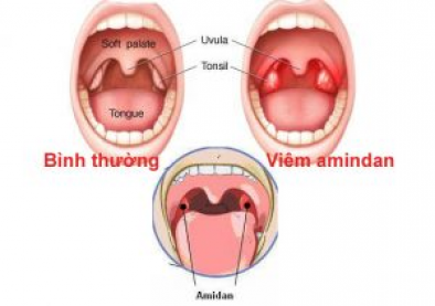 Thông tin về Amidan quá phát ở trẻ em ĐẦY ĐỦ nhất