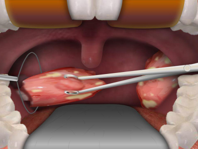 Trẻ bị viêm amidan có mủ là bệnh gì? có nguy hiểm không?