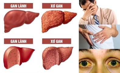 Những dấu hiệu cảnh báo bạn có thể bị xơ gan