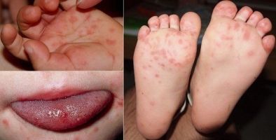 Signs and stages of development of hand, foot and mouth disease in children