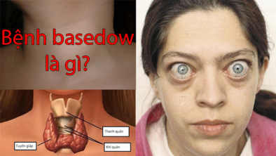 Bệnh Basedow là gì, triệu chứng nhận biết thế nào?