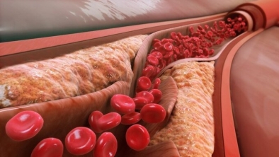 Cholesterol nguy hiểm thế nào nếu vượt quá mức cho phép?