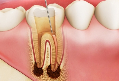 Viêm tủy răng có triệu chứng gì, biến chứng nguy hiểm hay không?