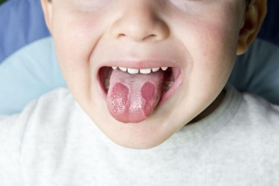 Những bệnh lý răng miệng thường gặp ở trẻ