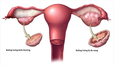 Biến chứng nguy hiểm của buồng trứng đa nang