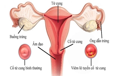 Top bệnh lý ở nữ làm tăng nguy cơ gây vô sinh