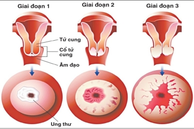 Ngại khám sản khoa, nhiều chị em bị ung thư giai đoạn cuối