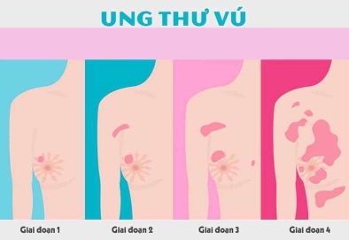 4 loại thực phẩm nhất định phải hạn chế để giảm nguy cơ ung thư vú