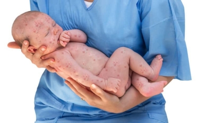 Rubella bẩm sinh là gì, có nguy hiểm không?