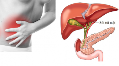 Bị sỏi mật có nguy hiểm đến tính mạng không