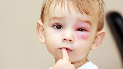 Cách chăm sóc trẻ khi bị đau mắt đỏ