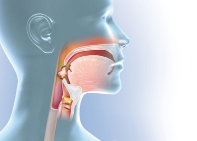 Nguyên nhân triệu chứng của bệnh Ung thư tai mũi họng