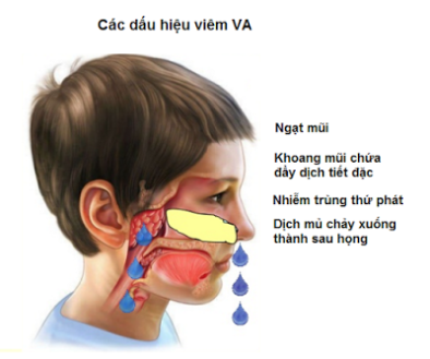 Những biểu hiện viêm VA ở trẻ