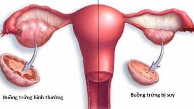 Các yếu tố liên quan để suy giảm dự trữ buồng trứng ở phụ nữ