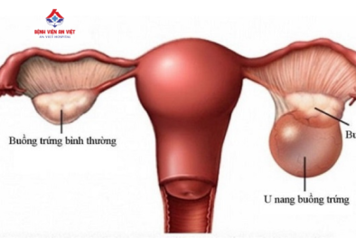 U nang buồng trứng nguy hiểm thế nào đến khả năng sinh sản của phụ nữ?