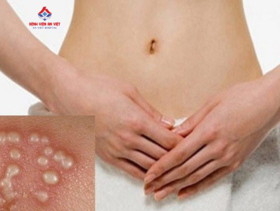 Herpes sinh dục lây qua những đường nào, điều trị ra sao?