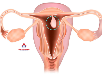 Polyp buồng tử cung- Kẻ thù thầm lặng ảnh hưởng tới khả năng sinh sản