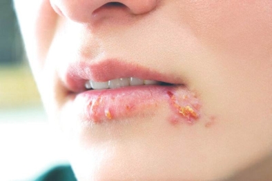 Mụn rộp Herpes có triệu chứng gì?