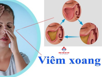 Người bệnh viêm xoang nên ăn gì và kiêng gì để nhanh khỏi?