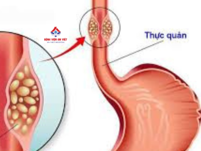 Cảm giác nghẹn ở thực quản: Nguyên nhân và cách điều trị