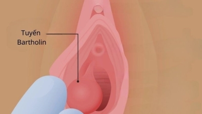 U nang tuyến bartholin là gì, có nguy hiểm không?